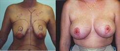 Breast Augmentation Patient Before & After Photo 1