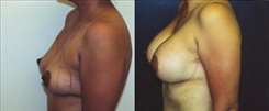 Breast Augmentation Patient Before & After Photo 1