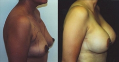 Breast Augmentation Patient Before & After Photo 1