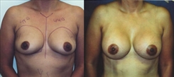 Breast Augmentation Patient Before & After Photo 1