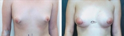 Breast Augmentation Patient Before & After Photo 1