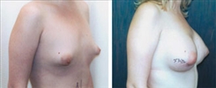 Breast Augmentation Patient Before & After Photo 1