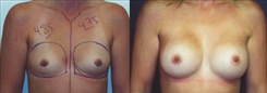 Breast Augmentation Patient Before & After Photo 1