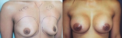 Breast Augmentation Patient Before & After Photo 1