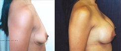 Breast Augmentation Patient Before & After Photo 1