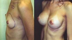 Breast Augmentation Patient Before & After Photo 1