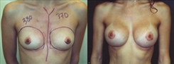 Breast Augmentation Patient Before & After Photo 1