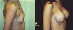 Breast Augmentation Patient Before & After Photo 1