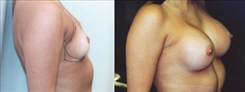 Breast Augmentation Patient Before & After Photo 1