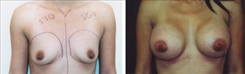 Breast Augmentation Patient Before & After Photo 1