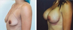 Breast Augmentation Patient Before & After Photo 1