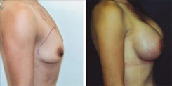 Breast Augmentation Patient Before & After Photo 1