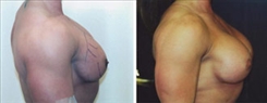 Breast Augmentation Patient Before & After Photo 1