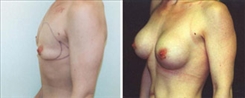 Breast Augmentation Patient Before & After Photo 1