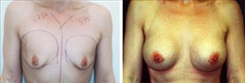 Breast Augmentation Patient Before & After Photo 1