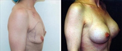 Breast Augmentation Patient Before & After Photo 1