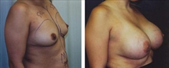 Breast Augmentation Patient Before & After Photo 1