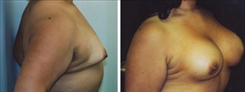 Breast Augmentation Patient Before & After Photo 1