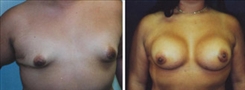 Breast Augmentation Patient Before & After Photo 1