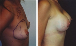 Breast Augmentation Patient Before & After Photo 1