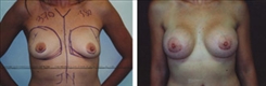 Breast Augmentation Patient Before & After Photo 1