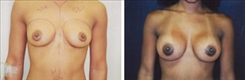 Breast Augmentation Patient Before & After Photo 1