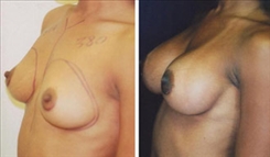 Breast Augmentation Patient Before & After Photo 1