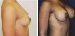 Breast Augmentation Patient Before & After Photo 1