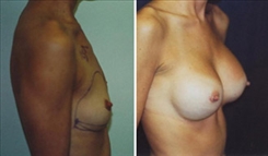 Breast Augmentation Patient Before & After Photo 1