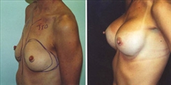 Breast Augmentation Patient Before & After Photo 1