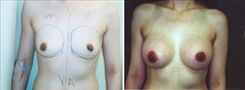 Breast Augmentation Patient Before & After Photo 1