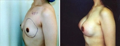 Breast Augmentation Patient Before & After Photo 1