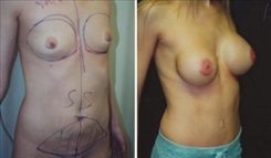 Breast Augmentation Patient Before & After Photo 1