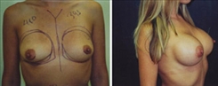 Breast Augmentation Patient Before & After Photo 1