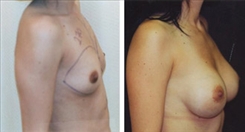 Breast Augmentation Patient Before & After Photo 1