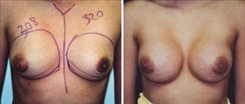 Breast Augmentation Patient Before & After Photo 1