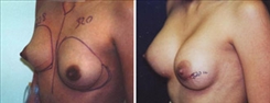 Breast Augmentation Patient Before & After Photo 1