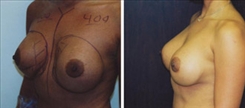 Breast Augmentation Patient Before & After Photo 1