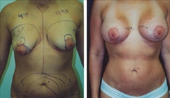 Breast Augmentation Patient Before & After Photo 1