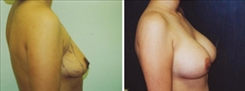 Breast Augmentation Patient Before & After Photo 1