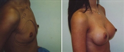 Breast Augmentation Patient Before & After Photo 1