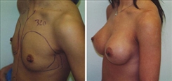 Breast Augmentation Patient Before & After Photo 1