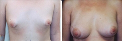 Breast Augmentation Patient Before & After Photo 1