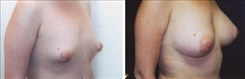 Breast Augmentation Patient Before & After Photo 1