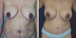 Breast Augmentation Patient Before & After Photo 1