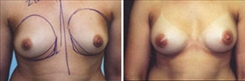 Breast Augmentation Patient Before & After Photo 1