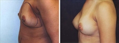 Breast Augmentation Patient Before & After Photo 1