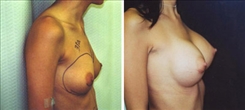 Breast Augmentation Patient Before & After Photo 1