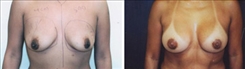 Breast Augmentation Patient Before & After Photo 1