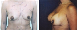 Breast Augmentation Patient Before & After Photo 1